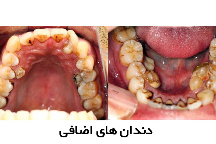 دندان اضافه(هایپردونتیا) چیست