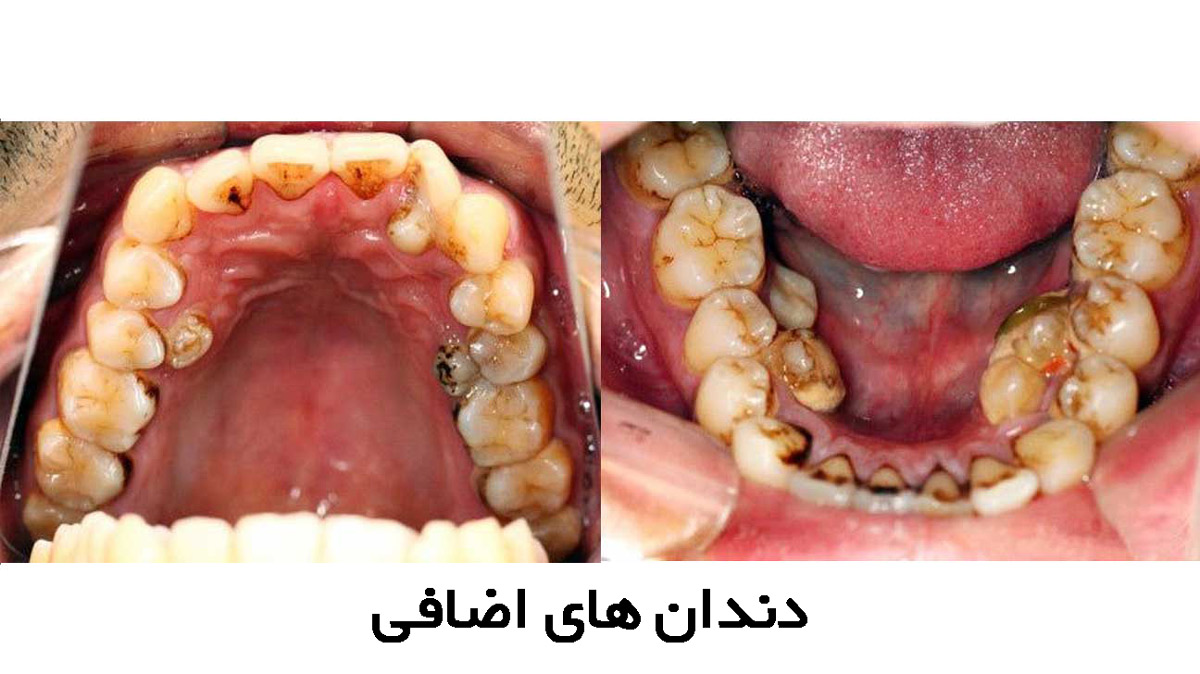 دندان اضافه(هایپردونتیا) چیست