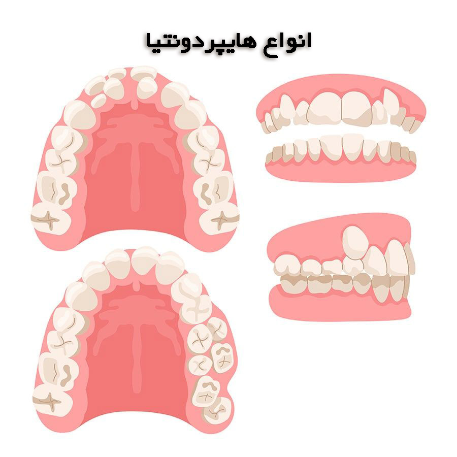 انواع دندان های اضافی