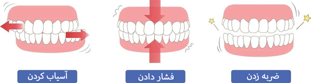 انواع دندان قروچه