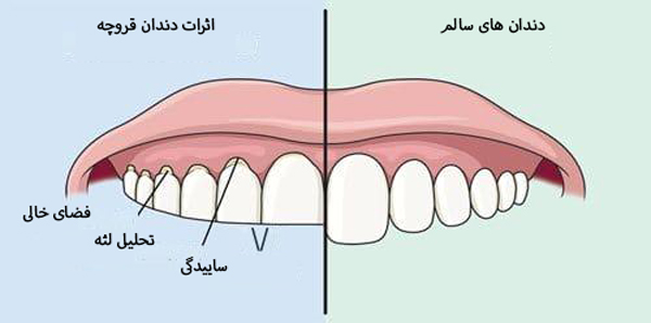 دندان قروچه چیست؟